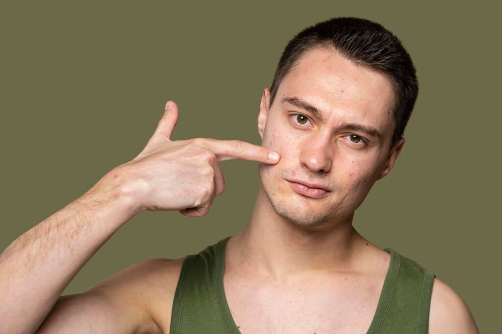 How to Use Glycolic Acid for Acne